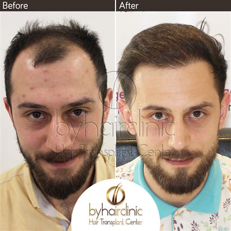 hair restoration in istanbul turkey